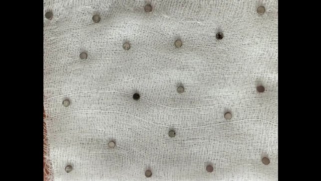 Çocuğun boğazından 19 adet mıknatıs çıkartıldı