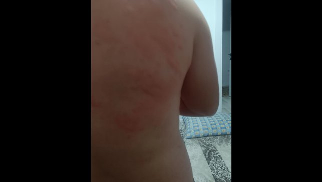 Elazığ'da böcek ısırığı hastanelik etti