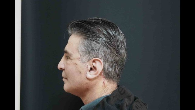 Bitlis'te ilk defa yüz germe ameliyatı başarıyla yapıldı