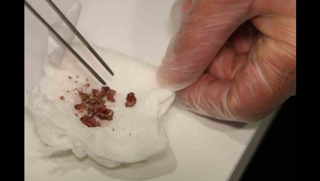 Elazığ'da estetik ameliyatta şaşırtan olay, burundan taş çıktı