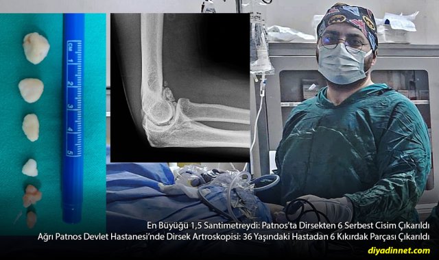 Patnos'ta Başarılı Dirsek Ameliyatı: Eklemden 6 Kıkırdak Parçası Çıkarıldı