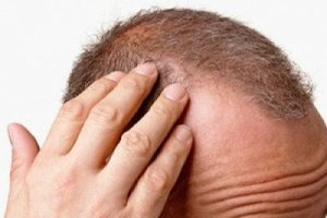 Saç Dökülmesi Neden Olur