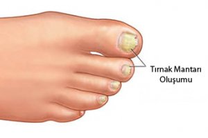 Tırnak mantarı nasıl bulaşır