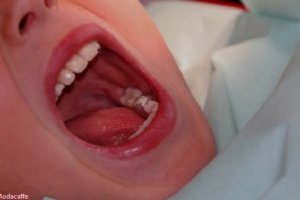 Diş Ağrısı Nasıl Geçer