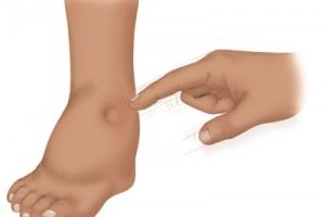 Vücutta Ödem Oluşumu Sebepleri ve Önlemenin Yolları