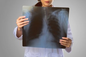 Akciğer kanseri belirtileri