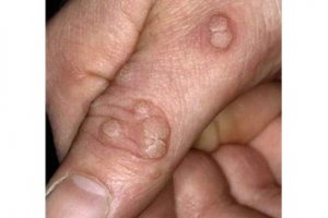 Siğil tedavisi nasıl yapılmalıdır ?