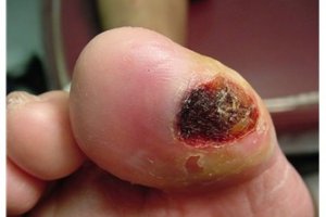 Diyabetik ayak yarası