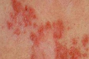 Güneş ışınları Deri Kanserine