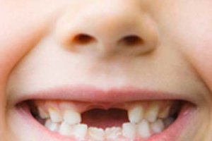 Çocuklarda Diş Çürüklerini Önlemenin Yolu