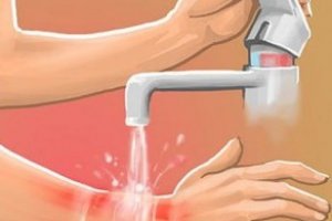 Yanıklarda ne yapılmalı Yanığa Ne İyi Gelir