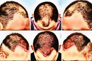 Saç Ekimi Nasıl Yapılır?