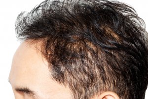 Natürel Saç Ekimi ve Fiyatları