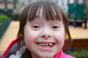 Bir Genetik Hastalığı: Down Sendromu