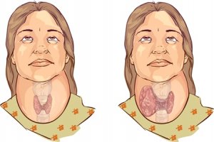 Guatr Hastalığı Nedir, Guatr Neden Oluşur ve Tedavisi Nasıldır