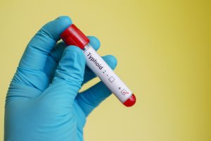 Tifo Hastalığının Sebepleri ve Tifodan Korunma Yolları