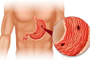 Mide Ülserinin Tanımı, Sebepleri ve Tedavi Yöntemleri