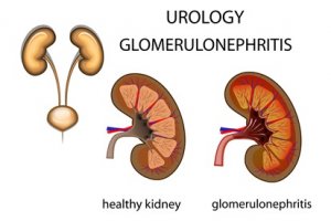 Nefrit Ne Demektir, Nefritin Çeşitleri, Nefrit Tedavisi
