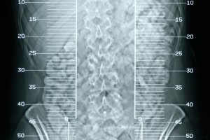 Kemik Erimesi Osteoporoz Nedir, Kemik Erimesi Tedavisi Nasıl Yapılır