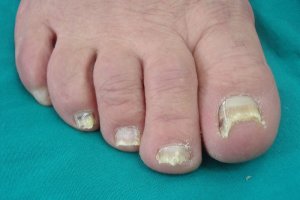 Onikomikoz Nedir? Onikomikoz tedavisi nasıl yapılır?