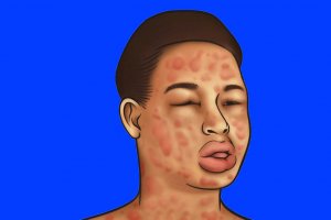 Anafilaksi: anafilaktik alerjik şok