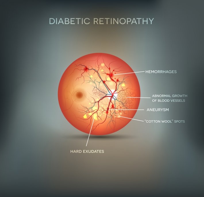 Diyabetik Retinopati Nedir Diyabetik Retinopati Belirtileri ve Tedavisi