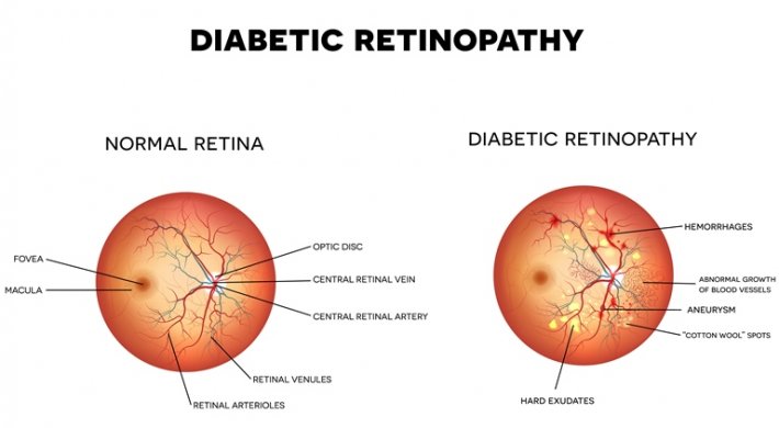 Diyabetik Retinopati tedavi edilirmi