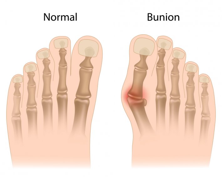 Halluks Valgus Ayaklarda Ağrıyla Ortaya Çıkan Çarpıklık