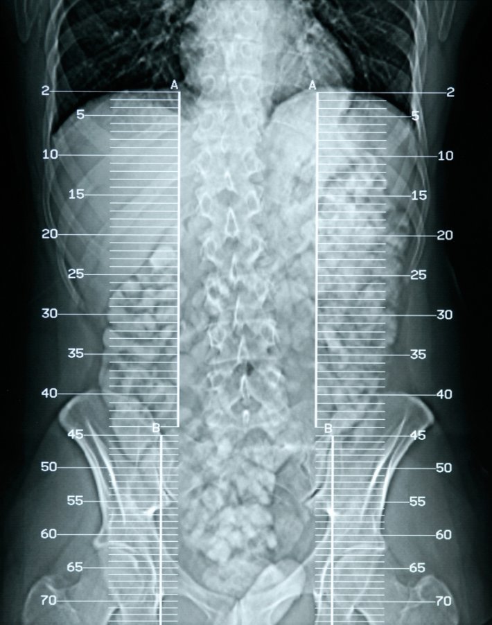 Kemik Erimesi Osteoporoz
