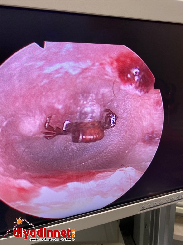 çıktı ağrı zarından hastaneye kadının Erzincan