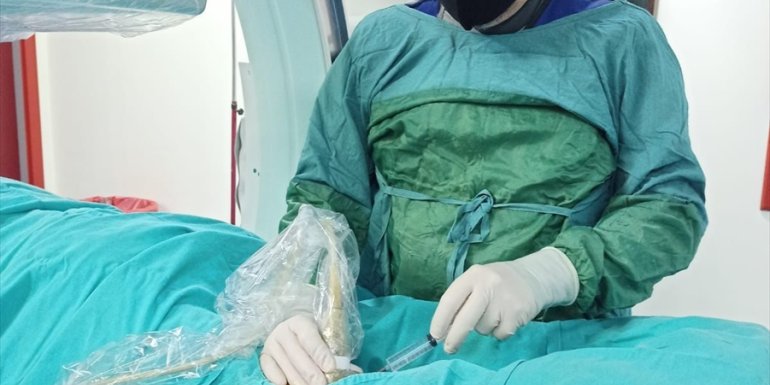 Ekstravasküler Remodelizasyon sistemiyle ilk kez derin venöz kapak tedavisi gerçekleştirildi