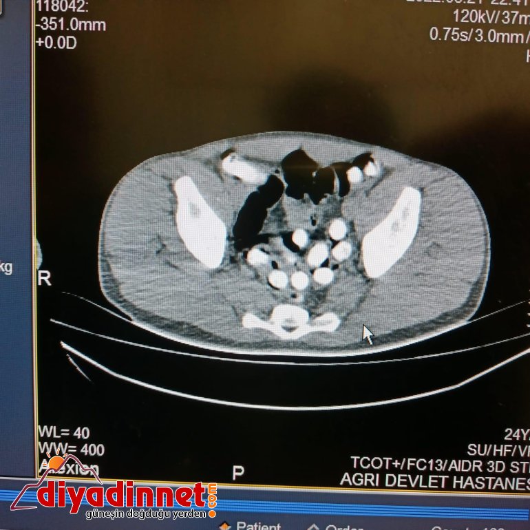 İranlı şüphelinin mide ve bağırsağından 1 kilo 126 gram uyuşturucu çıktı4