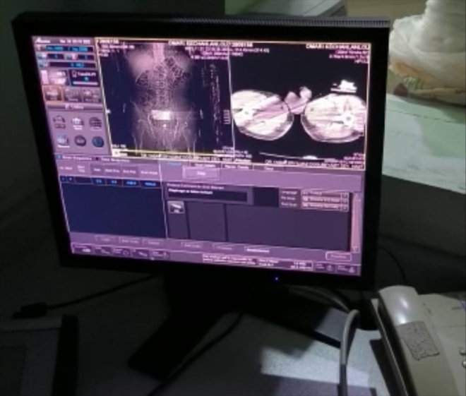 Ağrı'da iç organlarından uyuşturucu çıkarılan 4 zanlı tutuklandı