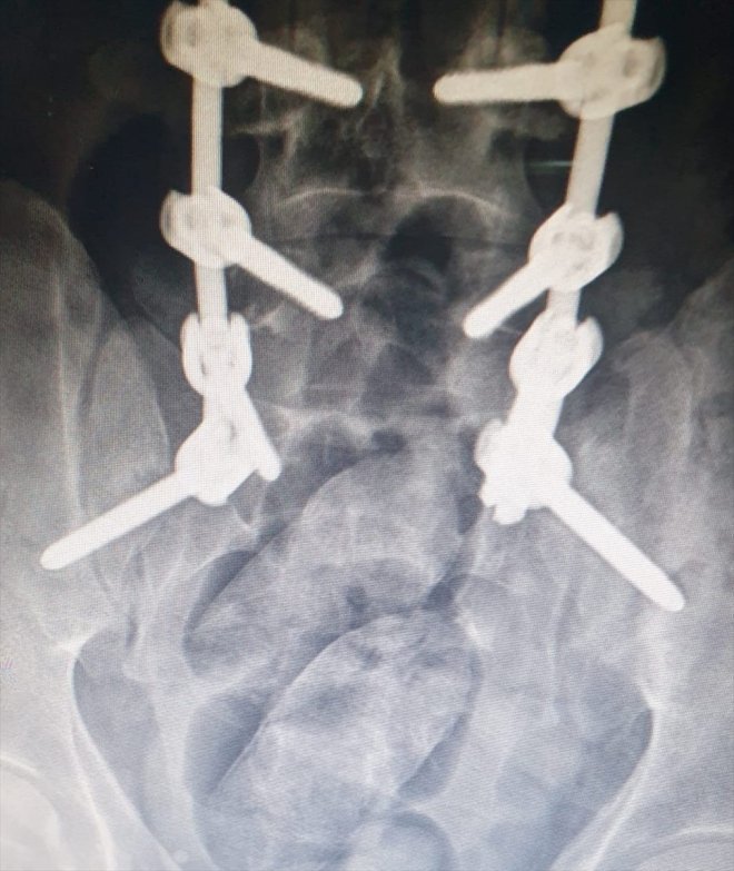 AĞRI çıkan İran tutuklandı şüpheli uyuşturucu - Midesinde uyruklu 2