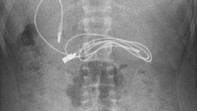 Elazığ'da 15 yaşındaki çocuğun midesinden şarj kablosu ve saç tokası çıkarıldı