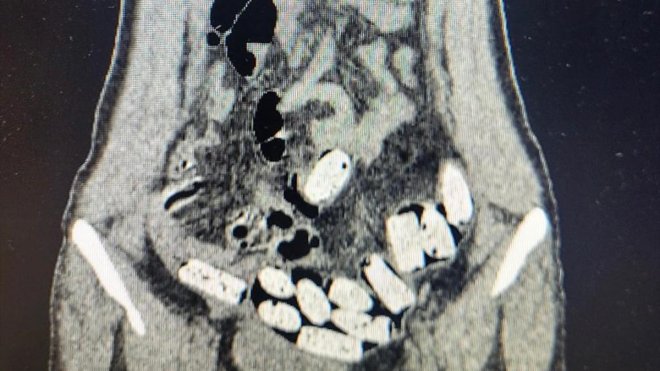 Erzurum'da iç çamaşırı, midesi ve bağırsaklarına uyuşturucu saklayan zanlı tutuklandı