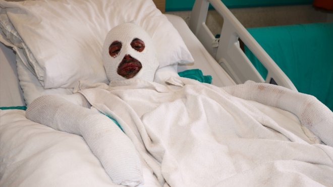 Gazı açıp sohbete dalan döner ustası çakmağı çakınca hastanelik oldu