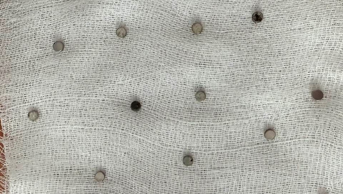 Elazığ'da 3 yaşındaki çocuğun yemek borusundan 19 mıknatıs çıkarıldı