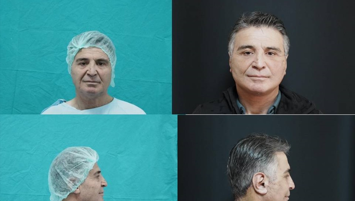 Bitlis'te ilk kez derin plan yüz germe ameliyatı yapıldı